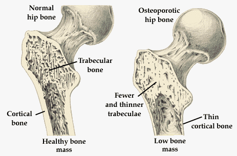 osteoporosis.gif